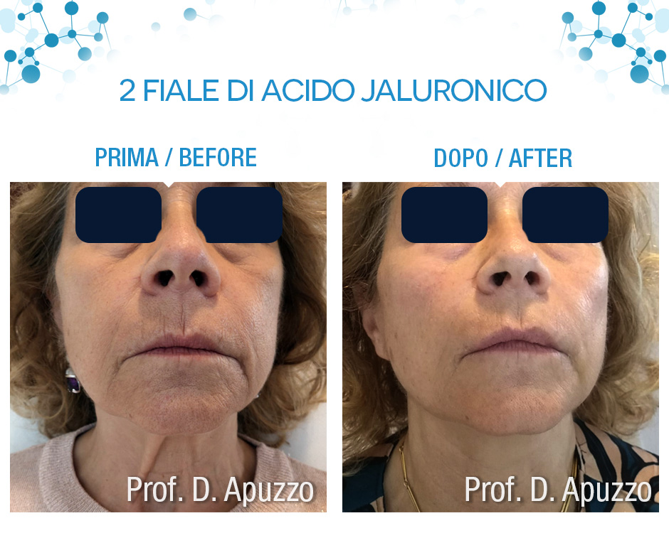 2 fiale di acido jaluronico