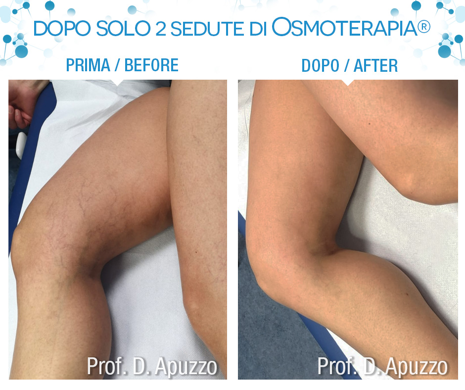 Dopo solo 2 sedute di Osmoterapia®