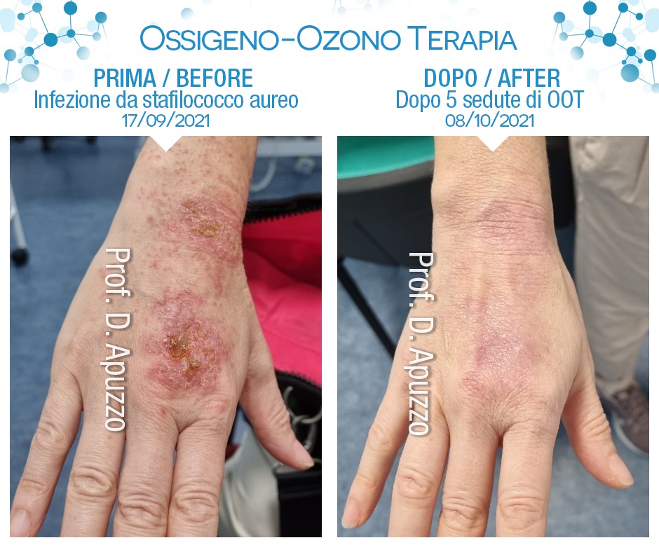 Infezione da stafilococco aureo dopo 5 sedute di Ossigeno-Ozono Terapia