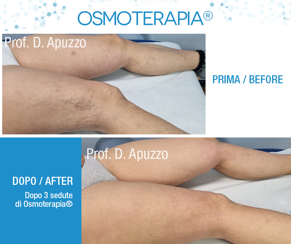 Dopo 3 sedute di Osmoterapia® 04.05.2022