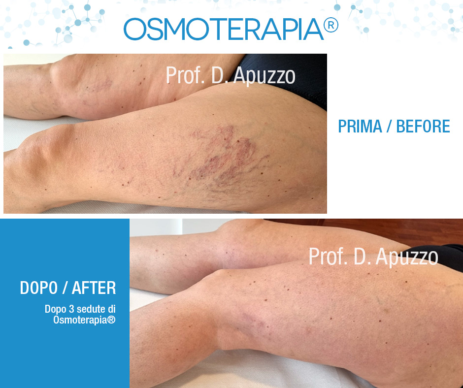 Dopo solo 3 sedute di Osmoterapia ®