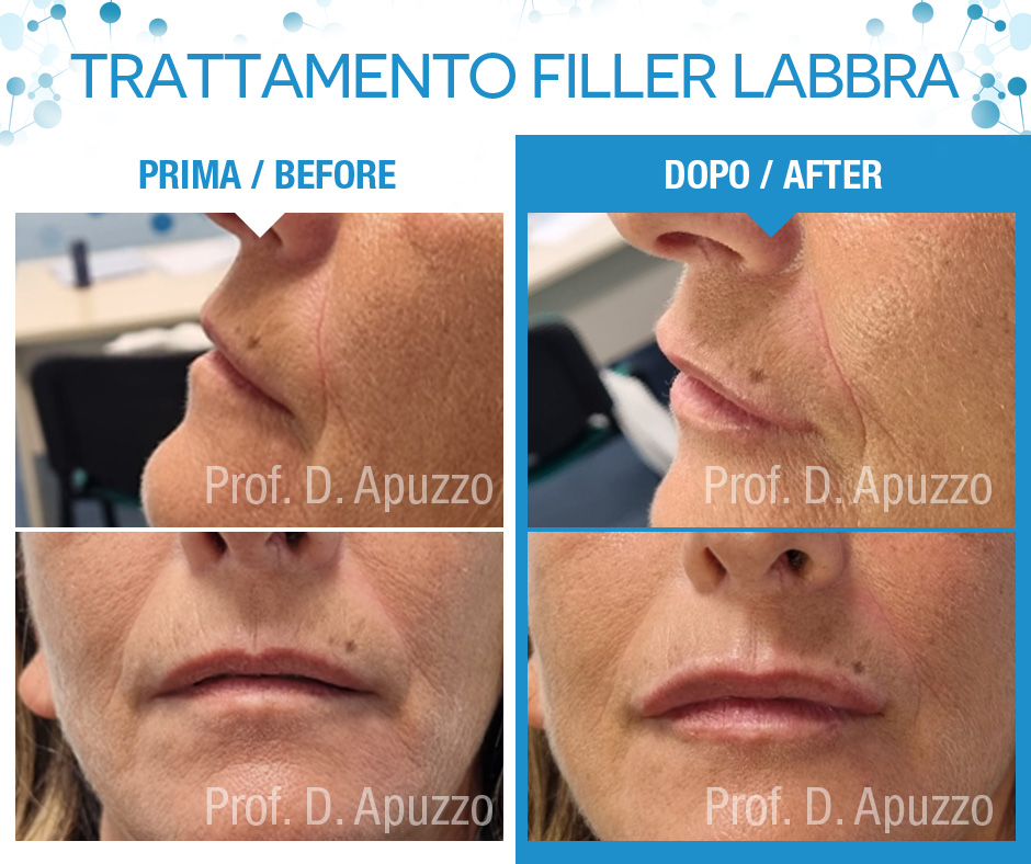 Trattamento filler labbra