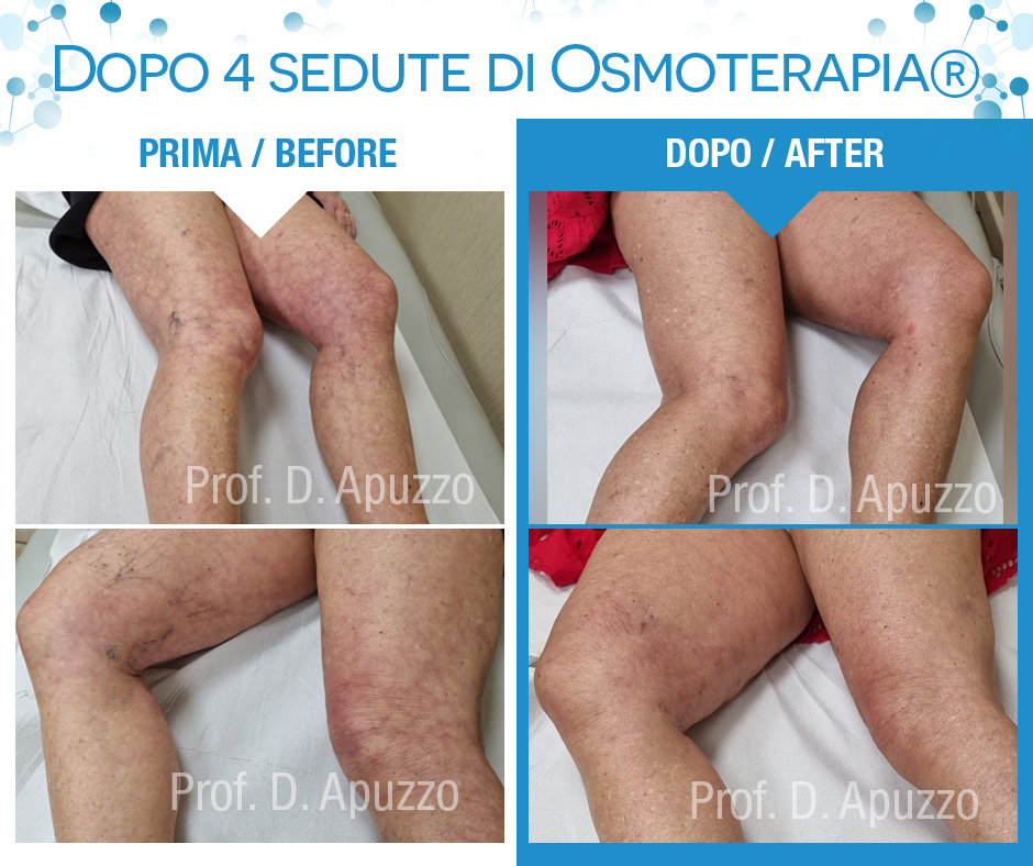Dopo 4 sedute di Osmoterapia®