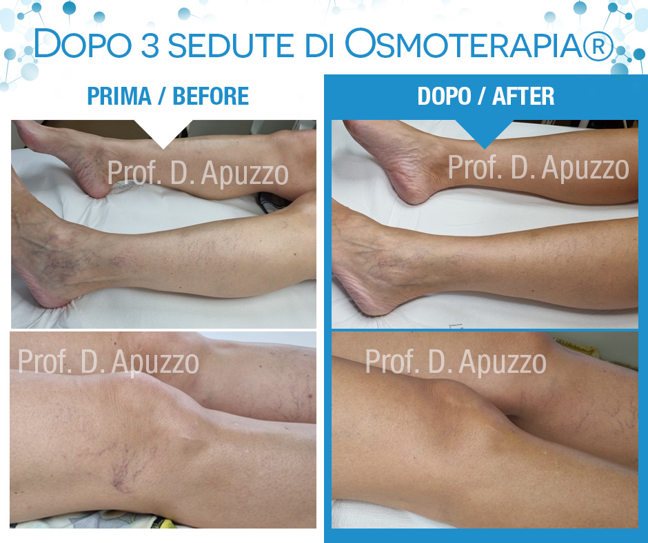 Dopo 3 sedute di Osmoterapia® 14.11.2022