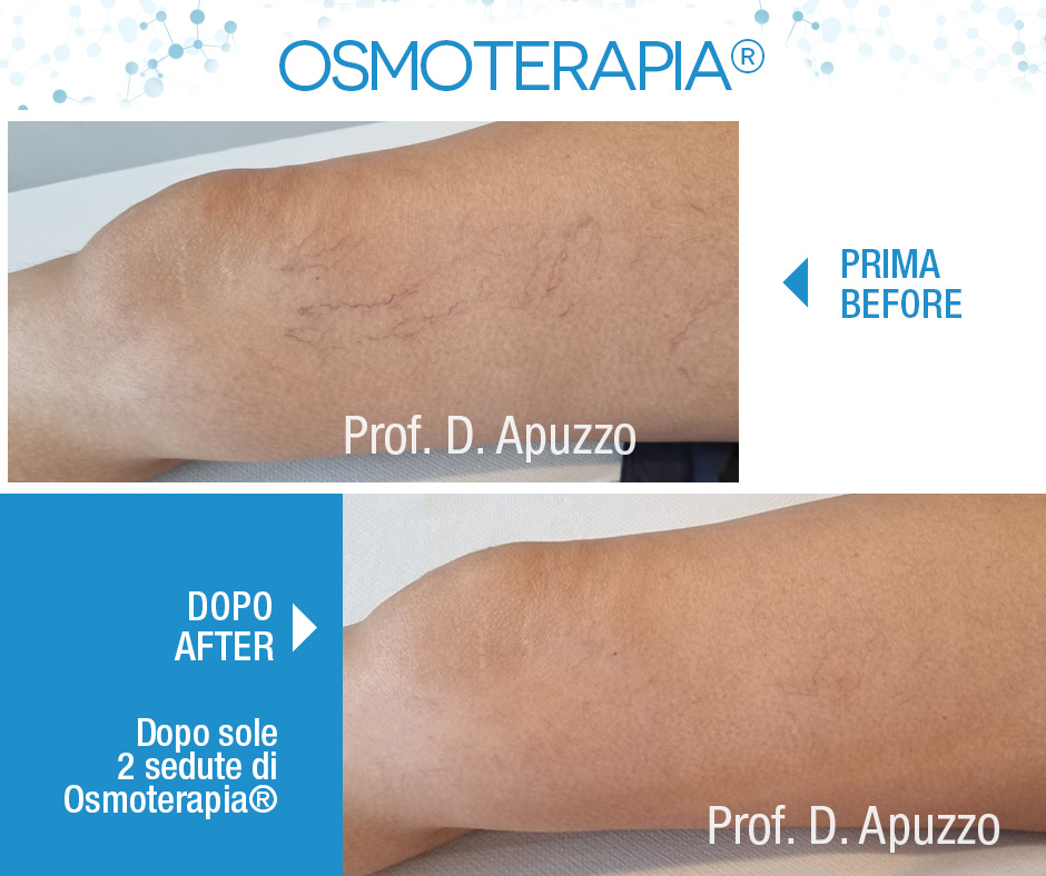 Dopo sole 2 sedute di Osmoterapia®