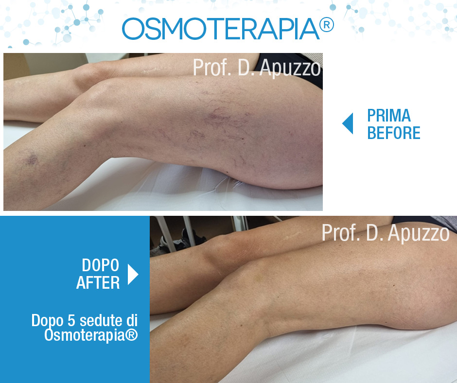 Risultati sui capillari dopo 5 sedute di Osmoterapia®