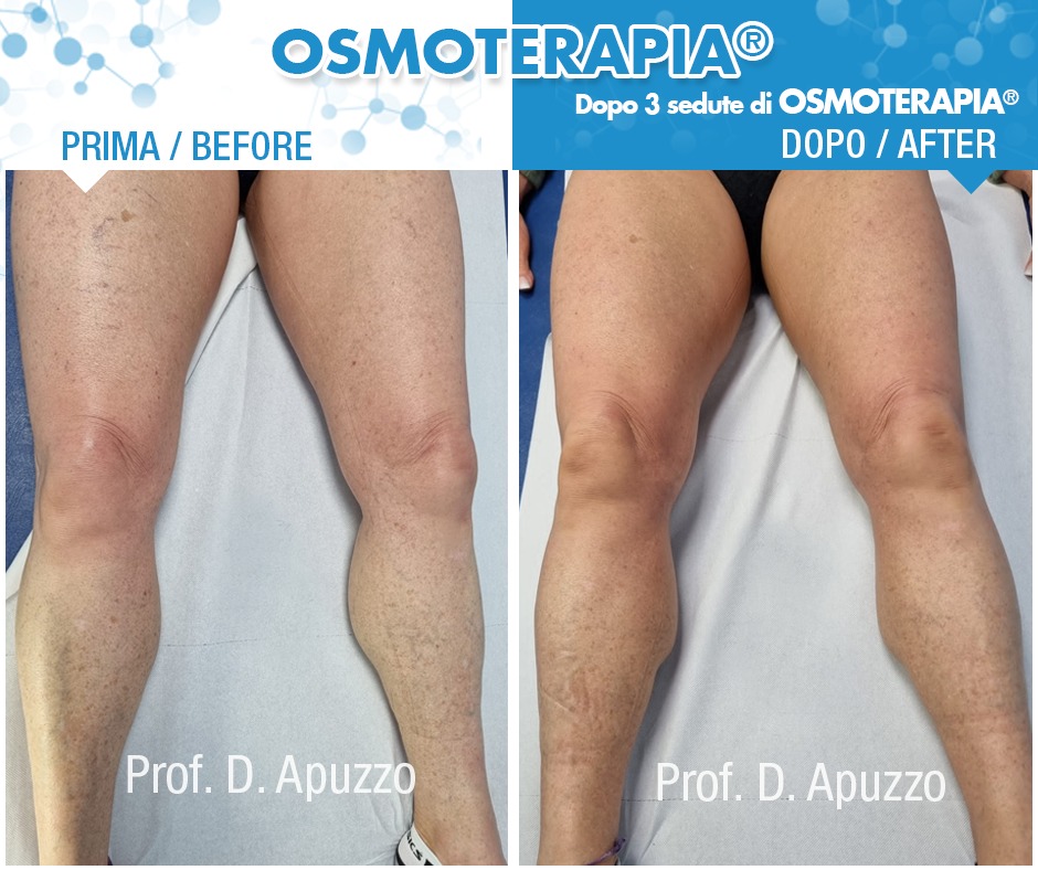 Dopo 3 sedute di Osmoterapia®